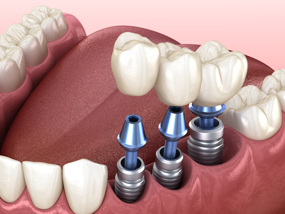 illustration of natural teeth and dental implants Lee's Summit, MO